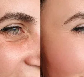 Botox Injections